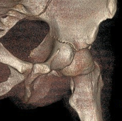 Acetabular Fracture Transverse